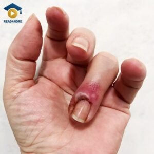 A close-up photograph of an inflamed finger showing clear signs of inflammation, specifically redness and swelling around the nail. This image is a visual example for the medical English term 'inflammation' in an OET preparation course on read4more.com.