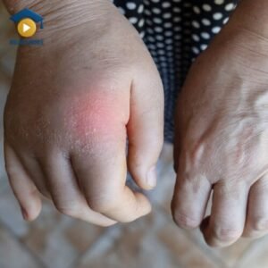 A clear, comparative image showing a person's normal hand next to their other hand which has significant swelling and redness, visually defining the term for a medical English lesson on read4more.com for OET preparation.